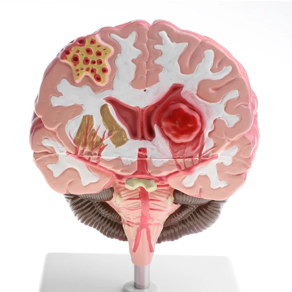 Versatile Maxbell Minification 1X Human Brain Brainstem Cerebral Hemorrhage Diseased Pathological Model Teaching Model High-End